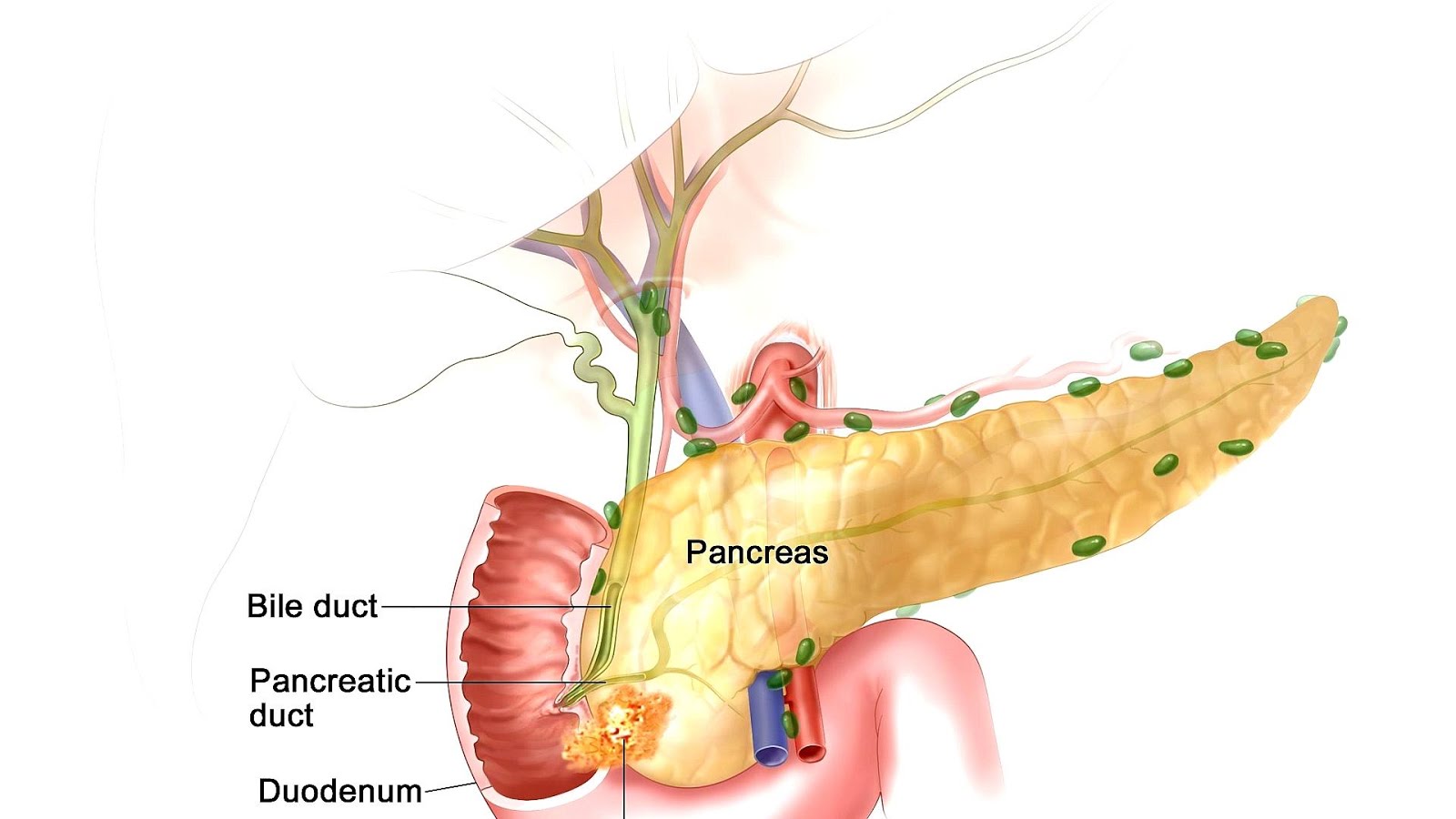 Cáncer de páncreas curado