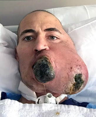 A Man who lost half his face to melon-size cancerous tumour gets Terminator-style transplant built by genius surgeon (graphic photos)