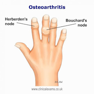 Heberdens-nodes-Osteoarthritis-600x600.jpg