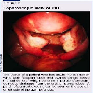 pelvic inflammatory laparoscopic pelvis