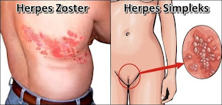 Obat Herbal Herpes Zoster dan Simplex