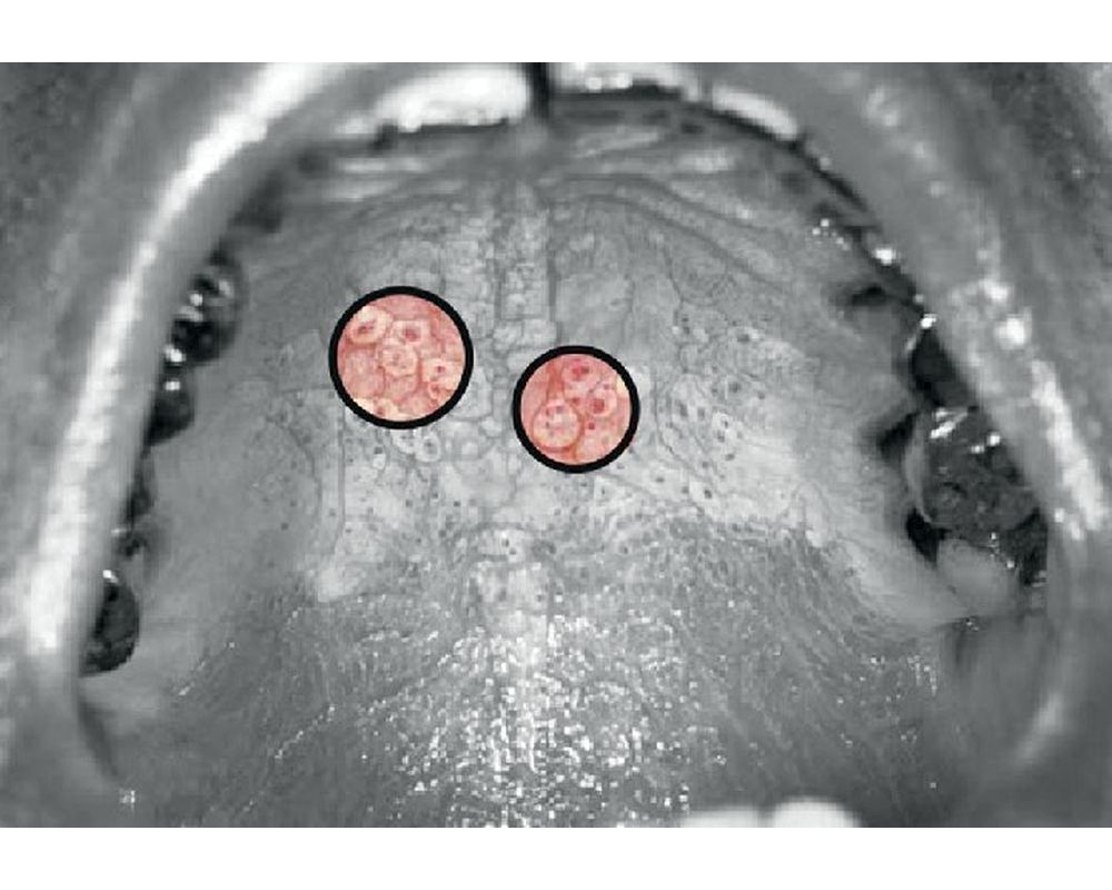 Smokeless Tobacco Lesions Nicotinic Stomatitis Treatment