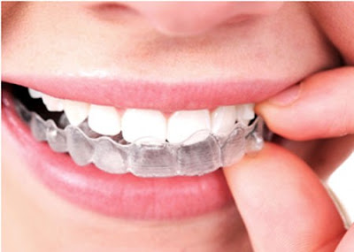 Niềng răng tại nhà có ưu điểm gì?