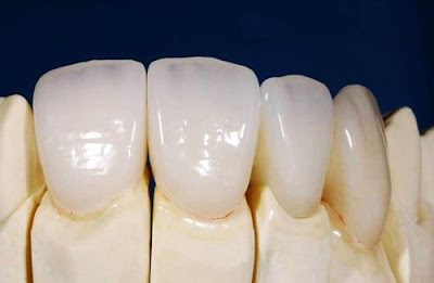 Bọc răng sứ duy trì được bao lâu?