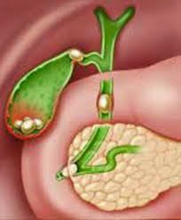 Πέτρες στα νεφρά κύστη χολή Πέτρες στα νεφρά κύστη χολή