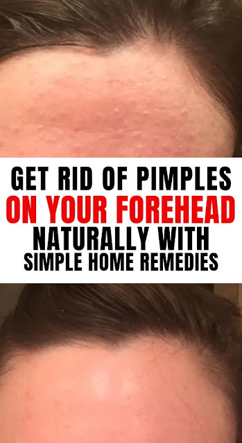 How to Get Rid Of Pimples on Forehead