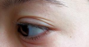 Rash Around the Eyes How to Treat It?