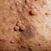Neurofibromatosis: Symptoms and Treatments