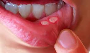 home-remedies-for-Mouth-ulcers