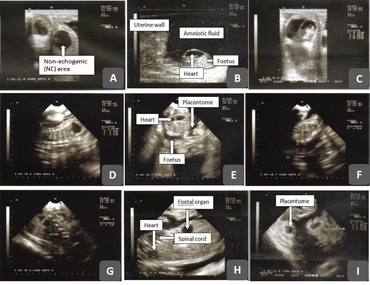 Ultrasonography (Usg) dan Aplikasinya Pada Pemeriksaan Organ Reproduksi