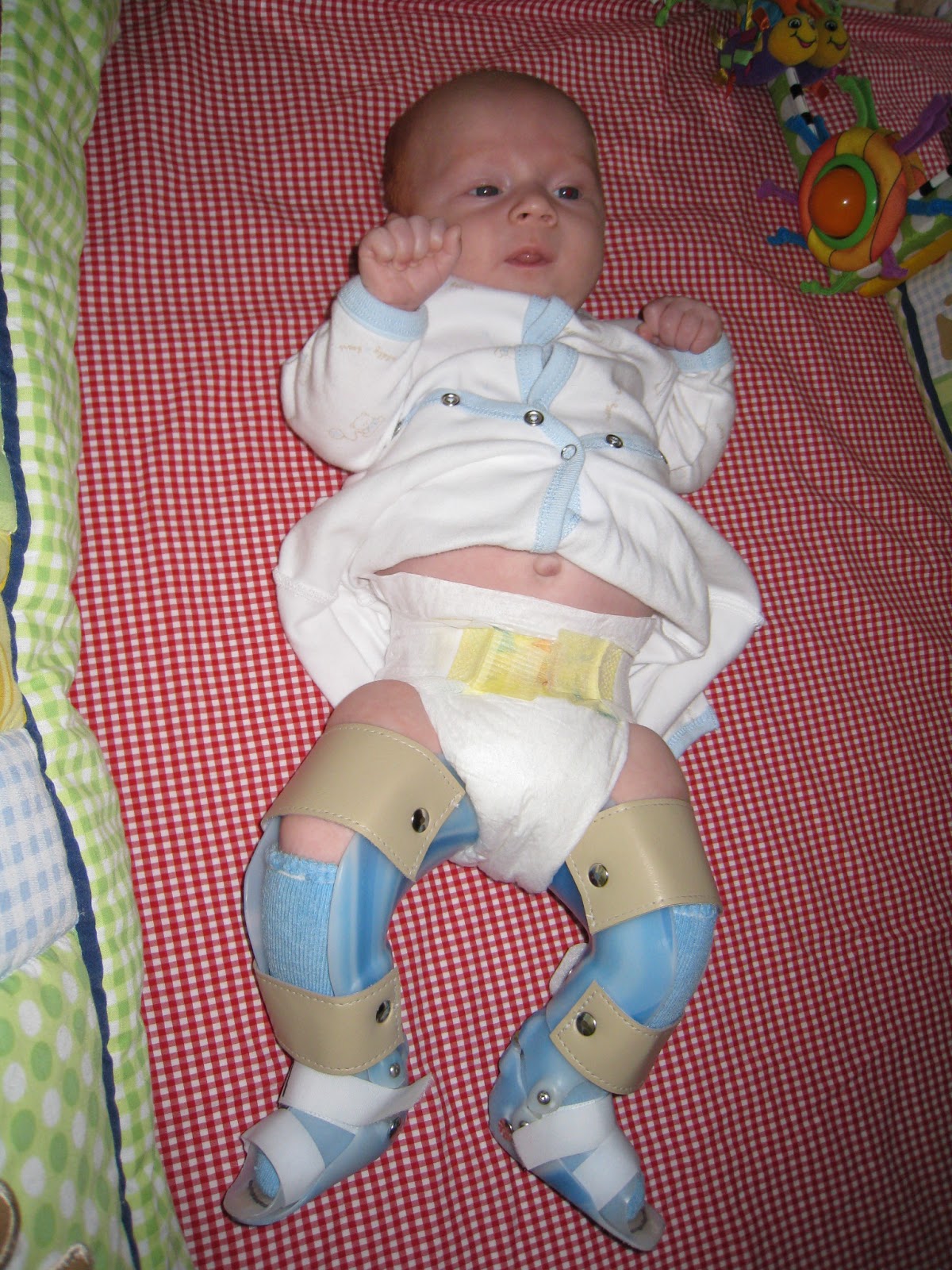 Their Little Footprints Oliver's Braces