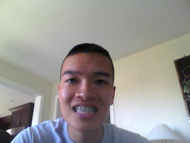 regeneration nerve aberrant gordon chin jaw surgery double tingling sign oculomotor idiopathic palsy