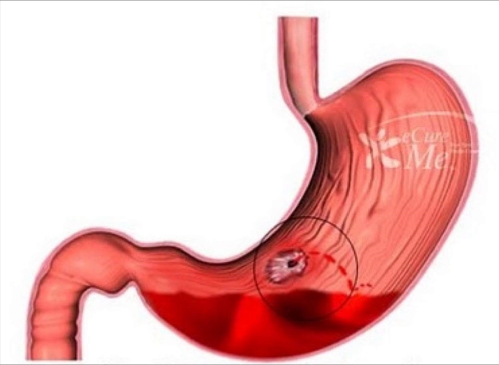 Hemorragia Digestiva Causas Y Síntomas Hemorragia Digestiva Causas Y Síntomas