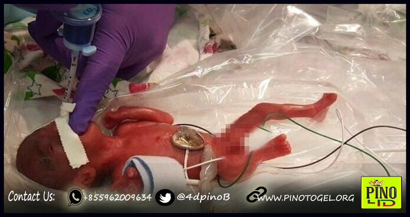 Bayi Yang lahir seberat apel bertahan hidup Pino 4D
