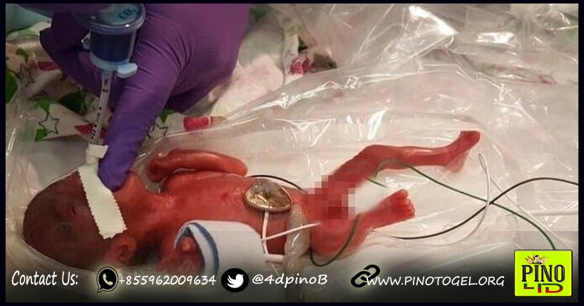 Bayi Yang lahir seberat apel bertahan hidup Pino 4D