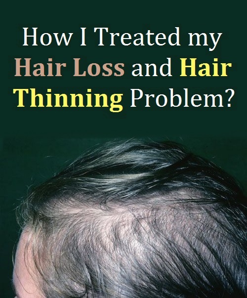 How I Treated my Hair Loss and Hair Thinning Problem? Beautypro Club