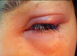 Cara Mengobati Kelopak Mata Bengkak Dan Gatal - Terkait Mata