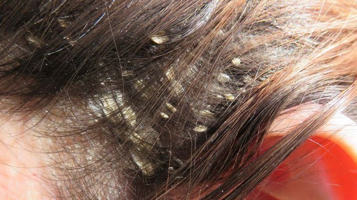 menghilangkan ketombe