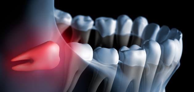 أسباب خلع ضرس العقل أسباب خلع ضرس العقل