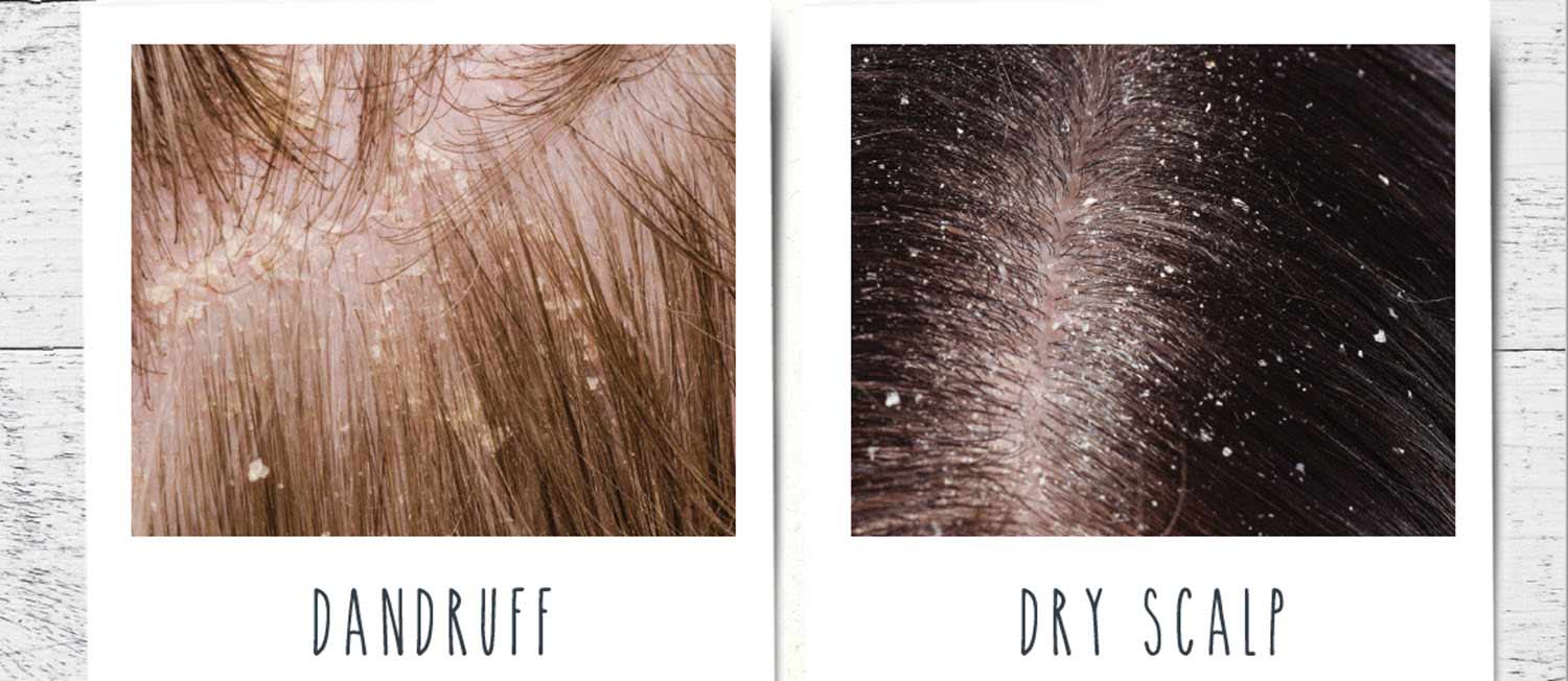 A Brief Overview Of Dandruff vs Dry Scalp Comparison