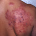 Tips dan cara menyembuhkan kulit melepuh dan berisi cairan bening | Obat Herpes 