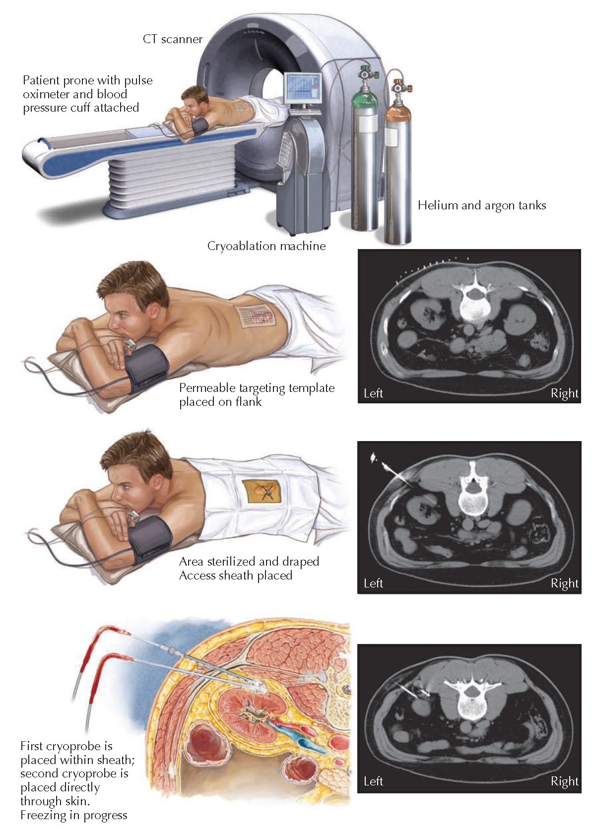 RENAL ABLATION pediagenosis