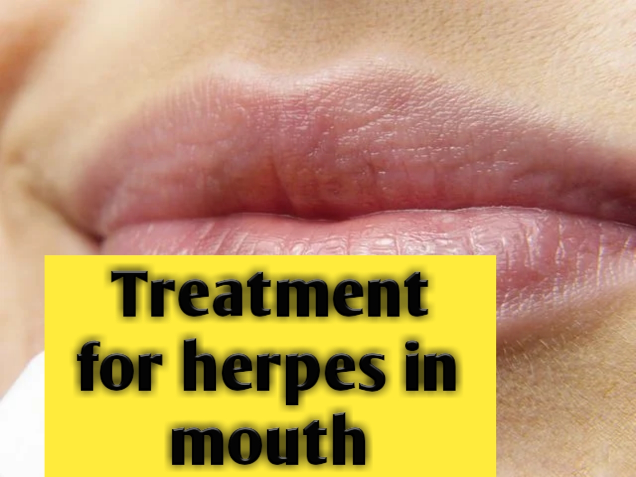 treatment-for-herpes-in-mouth