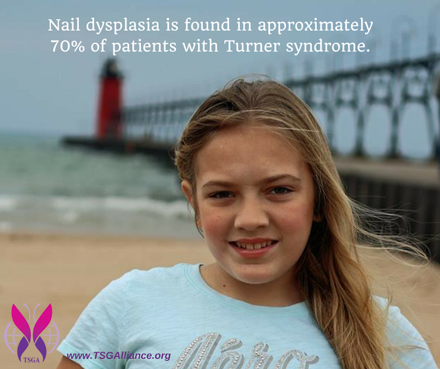 My Turner Syndrome Journey ABOUT TURNER SYNDROME