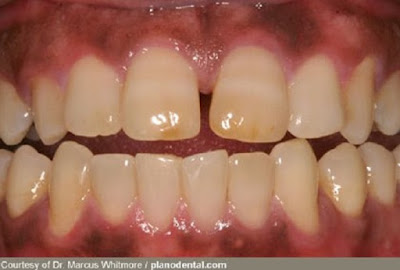 Mối quan hệ răng nướu và cách bệnh khác Tieu-duong-va-rang-nuou