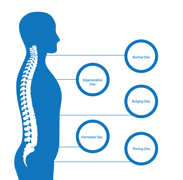 Get Best Ayurvedic Treatment Tips CERVICAL DISC BULGE Ayurvedic