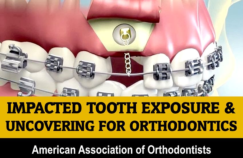 IMPACTED TOOTH Exposure & Uncovering For Orthodontics