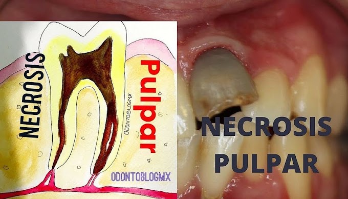 NECROSIS PULPAR: Definición, causas, tipos, síntomas, diagnóstico diferencial y tratamiento - Paulina Toledo