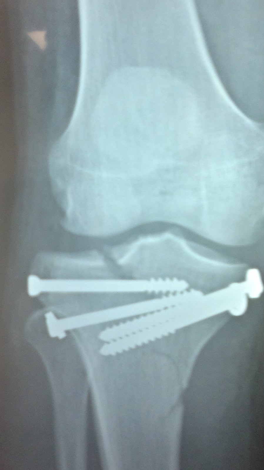 O R T O C R I T I C A Fractura de meseta tibial asociada a lesion ligamentaria O R T O C R I T I C A Fractura de meseta tibial asociada a lesion ligamentaria