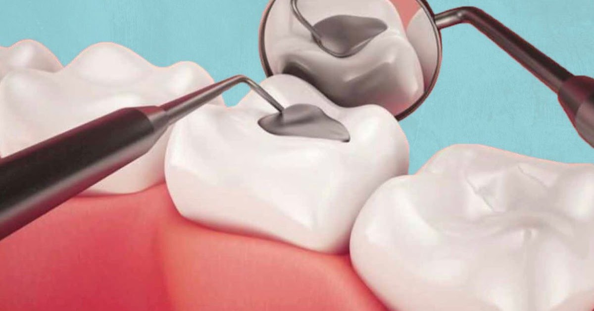 Resinas dentales Resinas dentales