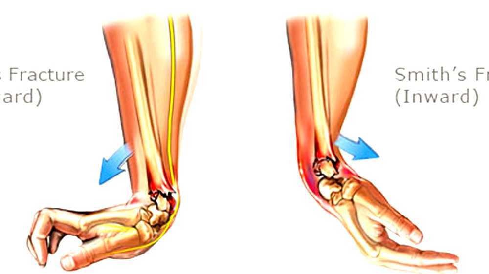 Distal radius fracture