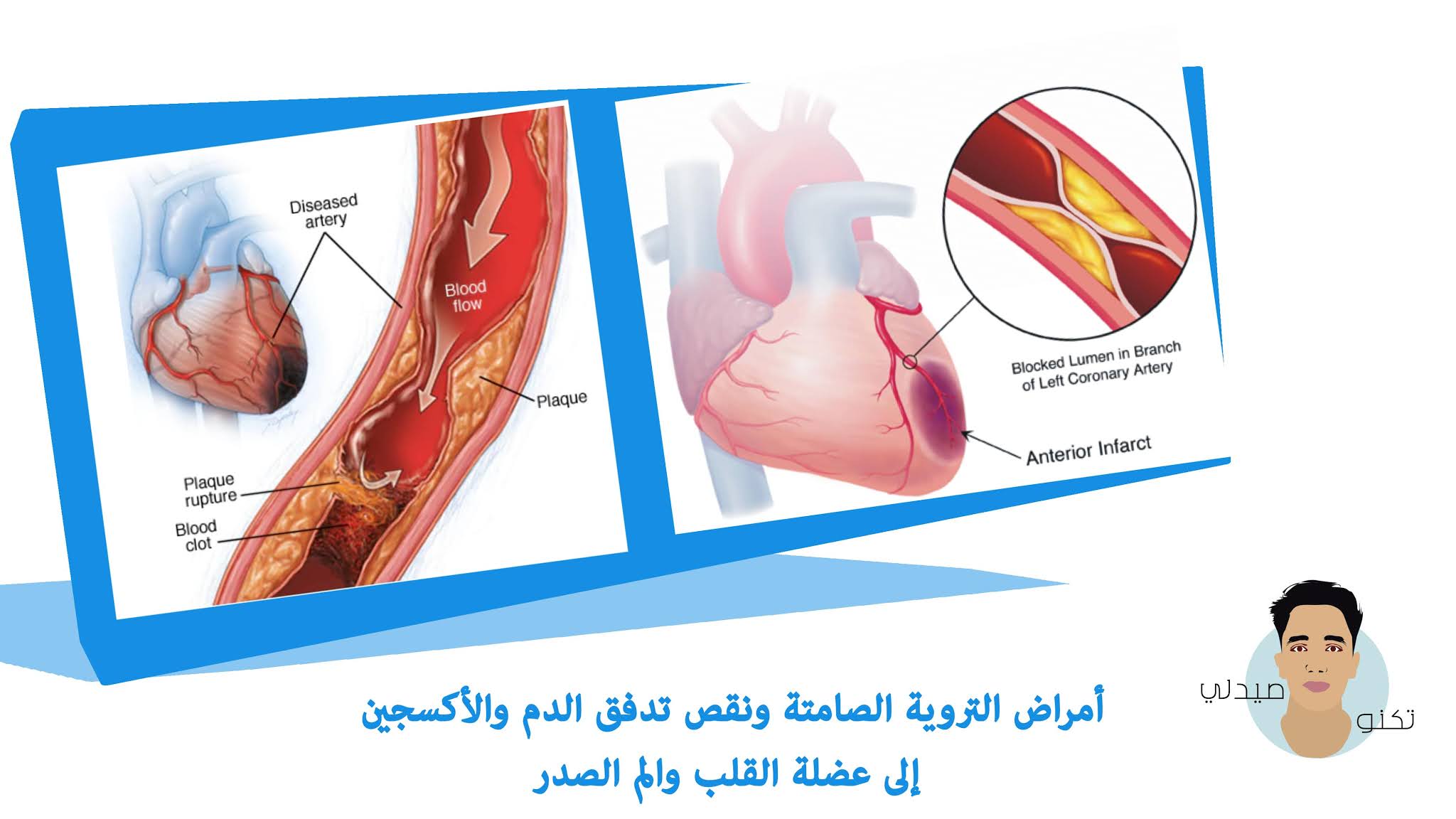 ما هو مرض القلب الإقفاري؟ ما هو مرض القلب الإقفاري؟