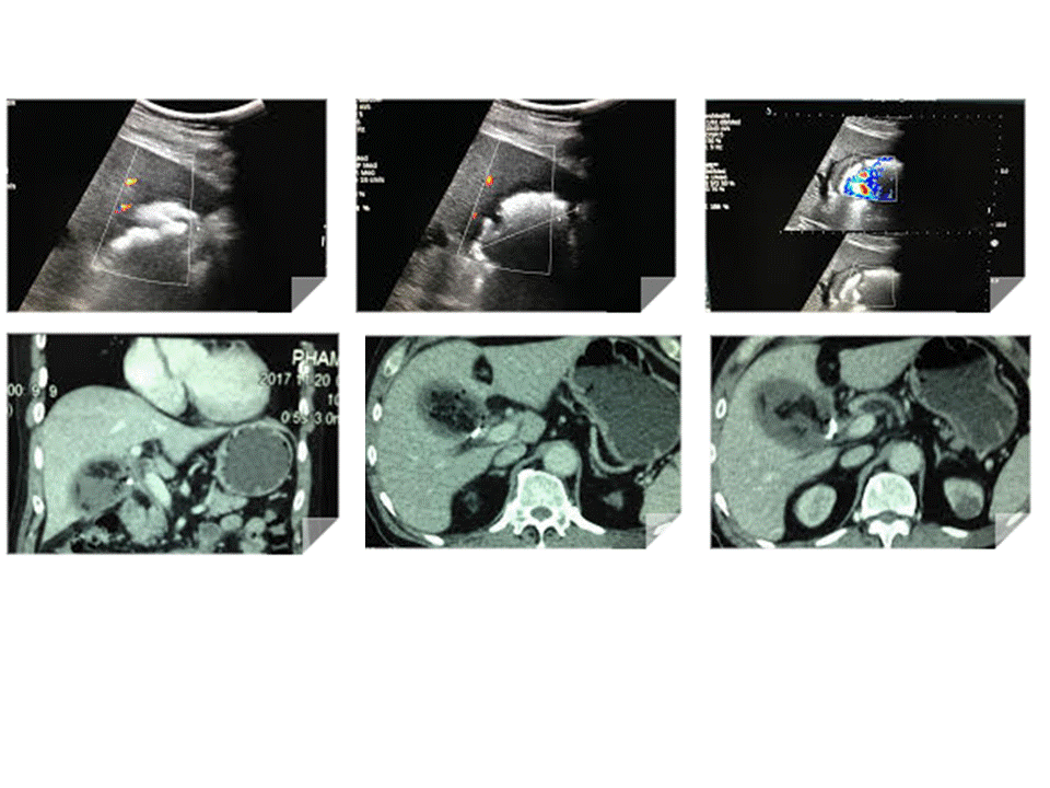 VIETNAMESE MEDIC ULTRASOUND CASE 462 LIVER ABSCESS POST ENDOSCOPIC