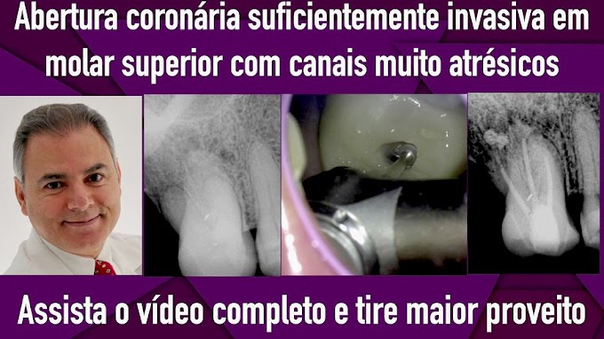 ENDODONTIA: Abertura coronária suficientemente invasiva em molar superior atrésico - Angelo Freire