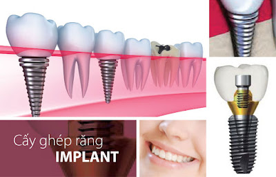Cấy ghép răng implant có hiệu quả không?