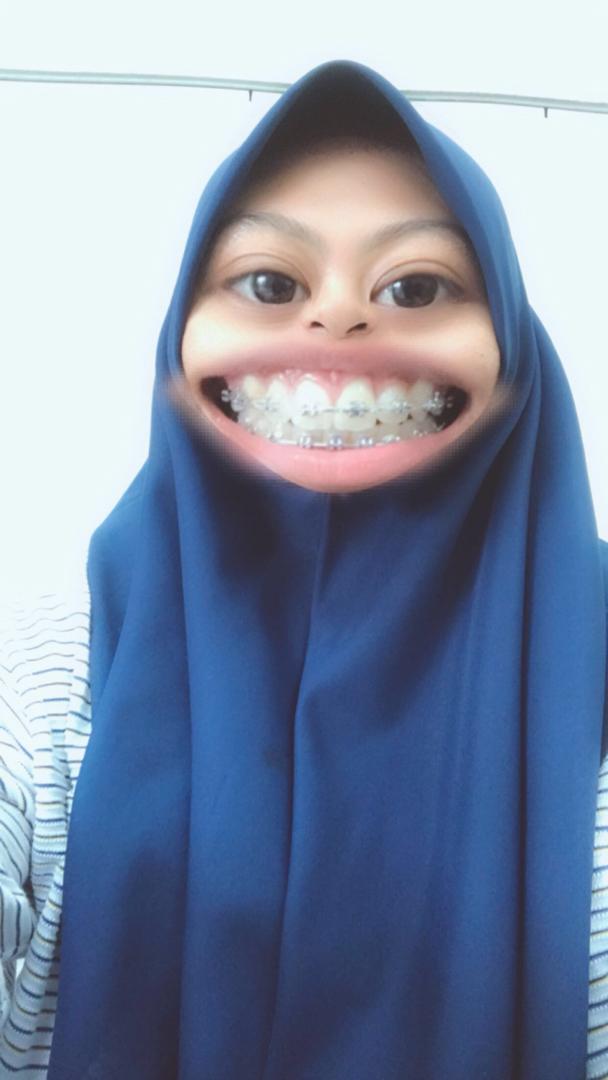 Braces Kerajaan Denaa Kiddo