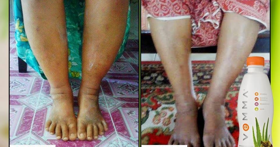 Ubat Bengkak Kaki Kucing  Contoh Yuk