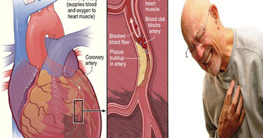 Obat Jantung Koroner Tradisional ~ Obat Herbal Ace Maxs