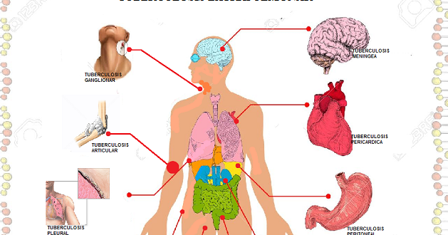 Signos y sintomas de la tuberculosis extrapulmonar