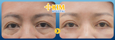 Hình ảnh khách hàng thực hiện cắt bọng mắt tại KIM Hospital.