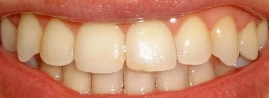 teeth after braces and crown lengthening albuquerque