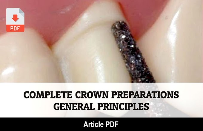 PDF: General principles for complete crown preparations