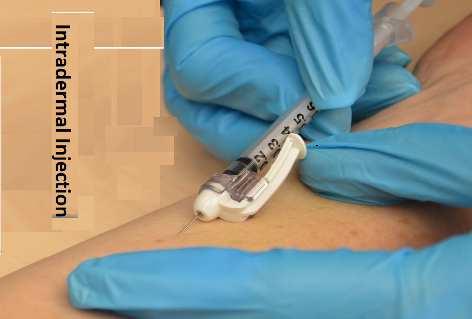 Sites of Intradermal injection And Complications