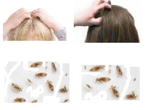 وصفة طبيعية للتخلص من حشرات الشعر للأطفال و للكبار القمل الصئبان فعالة و مجربة