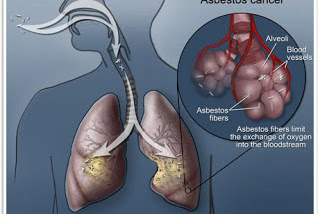 Mesothelioma Cancer and Asbestos