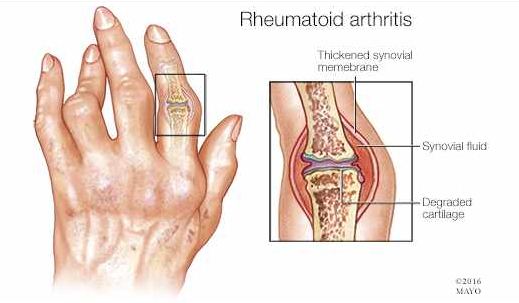 Artritis adalah